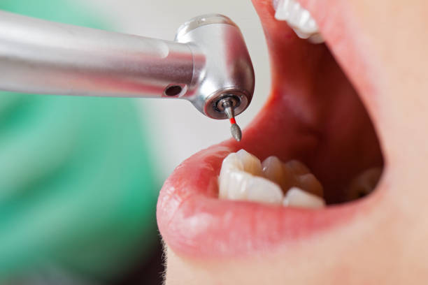 Best Emergency Root Canal Treatment in Grosse Pointe, MI